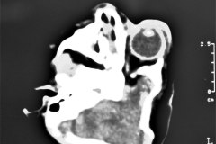 anencefalia-encefalocele-frontal-anoftalmia-der-tac-2000-008