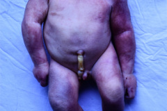 anencefalia-klippel-feil-raquisquisis-cervical-criptorquidia-bil-000