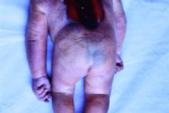 anencefalia-klippel-feil-raquisquisis-cervical-criptorquidia-bil-002