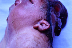 anencefalia-klippel-feil-raquisquisis-cervical-criptorquidia-bil-004