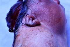 anencefalia-klippel-feil-raquisquisis-cervical-criptorquidia-bil-005