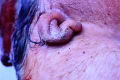 anencefalia-klippel-feil-sprengel-cuello-corto-brevicollis-mar-002