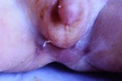 anencefalia-klippel-feil-sprengel-cuello-corto-brevicollis-mar-005