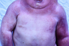 anencefalia-klippel-feil-sprengel-cuello-corto-brevicollis-mar-007