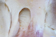 anencefalia-paladar-ojival-displasia-oreja-003