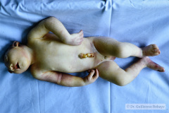 anencefalia-paladar-ojival-displasia-oreja-008