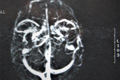 angiografia-cerebral-normal-1994-000
