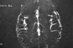 angiografia-cerebral-normal-1994-002