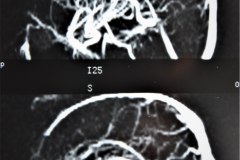 angiografia-cerebral-normal-1994-004