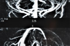 angiografia-cerebral-normal-1994-005