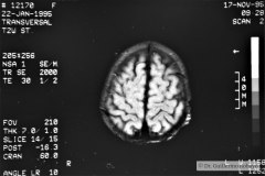 angioma-hemangioma-oseo-parietal-izq-tac-3m-rnm-10m-tac-5a-1995-001