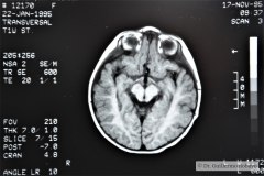 angioma-hemangioma-oseo-parietal-izq-tac-3m-rnm-10m-tac-5a-1995-005
