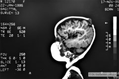 angioma-hemangioma-oseo-parietal-izq-tac-3m-rnm-10m-tac-5a-1995-006