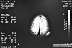 angioma-hemangioma-oseo-parietal-izq-tac-3m-rnm-10m-tac-5a-1995-007