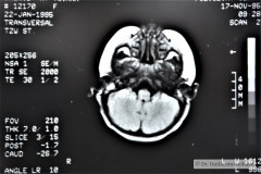 angioma-hemangioma-oseo-parietal-izq-tac-3m-rnm-10m-tac-5a-1995-008