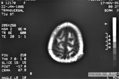 angioma-hemangioma-oseo-parietal-izq-tac-3m-rnm-10m-tac-5a-1995-009
