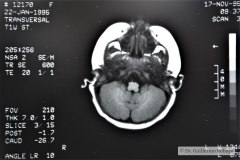 angioma-hemangioma-oseo-parietal-izq-tac-3m-rnm-10m-tac-5a-1995-010