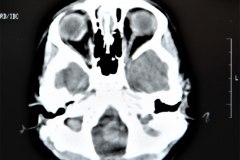 angioma-hemangioma-oseo-parietal-izq-tac-3m-rnm-10m-tac-5a-1995-012