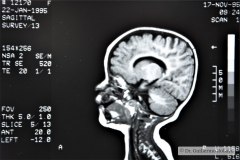 angioma-hemangioma-oseo-parietal-izq-tac-3m-rnm-10m-tac-5a-1995-013