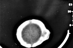 angioma-hemangioma-oseo-parietal-izq-tac-3m-rnm-10m-tac-5a-1995-016