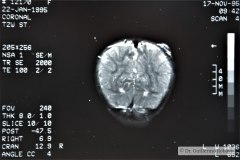 angioma-hemangioma-oseo-parietal-izq-tac-3m-rnm-10m-tac-5a-1995-021