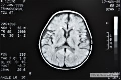 angioma-hemangioma-oseo-parietal-izq-tac-3m-rnm-10m-tac-5a-1995-023