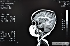 angioma-hemangioma-oseo-parietal-izq-tac-3m-rnm-10m-tac-5a-1995-024