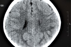 angioma-hemangioma-oseo-parietal-izq-tac-3m-rnm-10m-tac-5a-1995-025