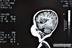 angioma-hemangioma-oseo-parietal-izq-tac-3m-rnm-10m-tac-5a-1995-026