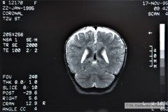 angioma-hemangioma-oseo-parietal-izq-tac-3m-rnm-10m-tac-5a-1995-028