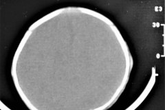 angioma-hemangioma-oseo-parietal-izq-tac-3m-rnm-10m-tac-5a-1995-030