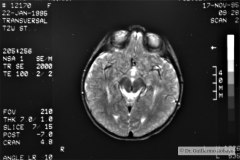 angioma-hemangioma-oseo-parietal-izq-tac-3m-rnm-10m-tac-5a-1995-031