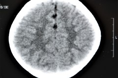 angioma-hemangioma-oseo-parietal-izq-tac-3m-rnm-10m-tac-5a-1995-034