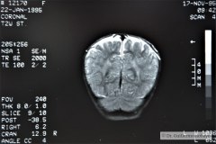 angioma-hemangioma-oseo-parietal-izq-tac-3m-rnm-10m-tac-5a-1995-035