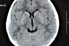 angioma-hemangioma-oseo-parietal-izq-tac-3m-rnm-10m-tac-5a-1995-036