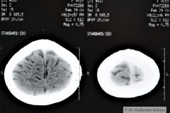 angioma-hemangioma-oseo-parietal-izq-tac-3m-rnm-10m-tac-5a-1995-038