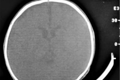 angioma-hemangioma-oseo-parietal-izq-tac-3m-rnm-10m-tac-5a-1995-040