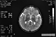 angioma-hemangioma-oseo-parietal-izq-tac-3m-rnm-10m-tac-5a-1995-043