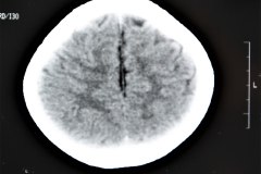 angioma-hemangioma-oseo-parietal-izq-tac-3m-rnm-10m-tac-5a-1995-047