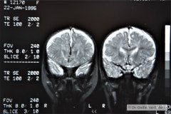 angioma-hemangioma-oseo-parietal-izq-tac-3m-rnm-10m-tac-5a-1995-048