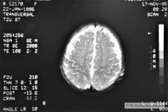 angioma-hemangioma-oseo-parietal-izq-tac-3m-rnm-10m-tac-5a-1995-057
