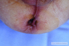 ano-tabicado-tabique-anal-001