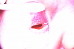 anoftalmia-der-005