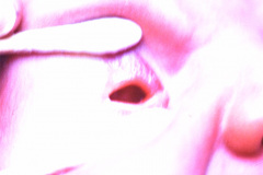 anoftalmia-der-011