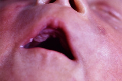 anoftalmia-micropene-hernia-inguinal-1989-000