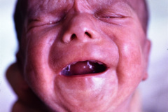 anoftalmia-micropene-hernia-inguinal-1989-001