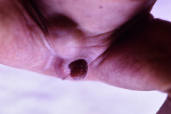 anoftalmia-micropene-hernia-inguinal-1989-002