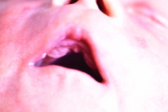 anoftalmia-micropene-hernia-inguinal-1989-003