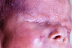 anoftalmia-micropene-hernia-inguinal-1989-005