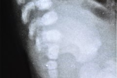 anomalia-sacro-y-articulacion-sacroiliaca-mar-1994-000